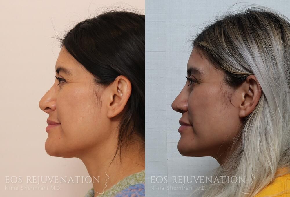 Revision Rhinoplasty Before & After
