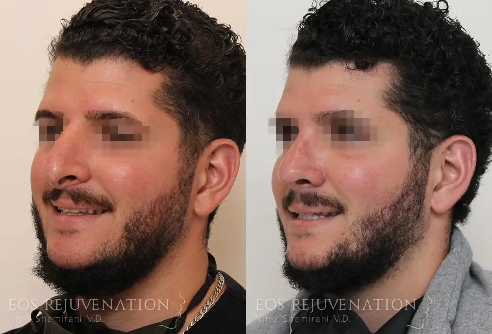 Revision Rhinoplasty Before & After