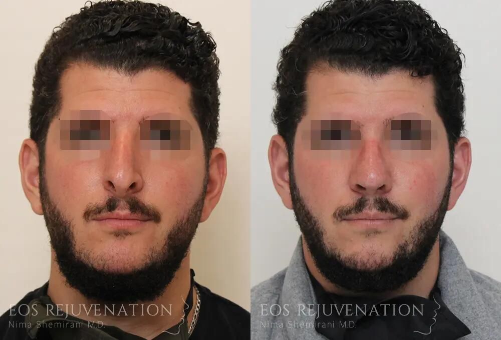 Revision Rhinoplasty Before & After