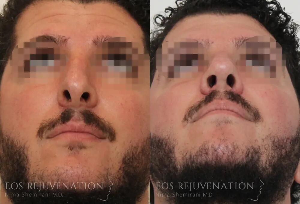 Revision Rhinoplasty Before & After