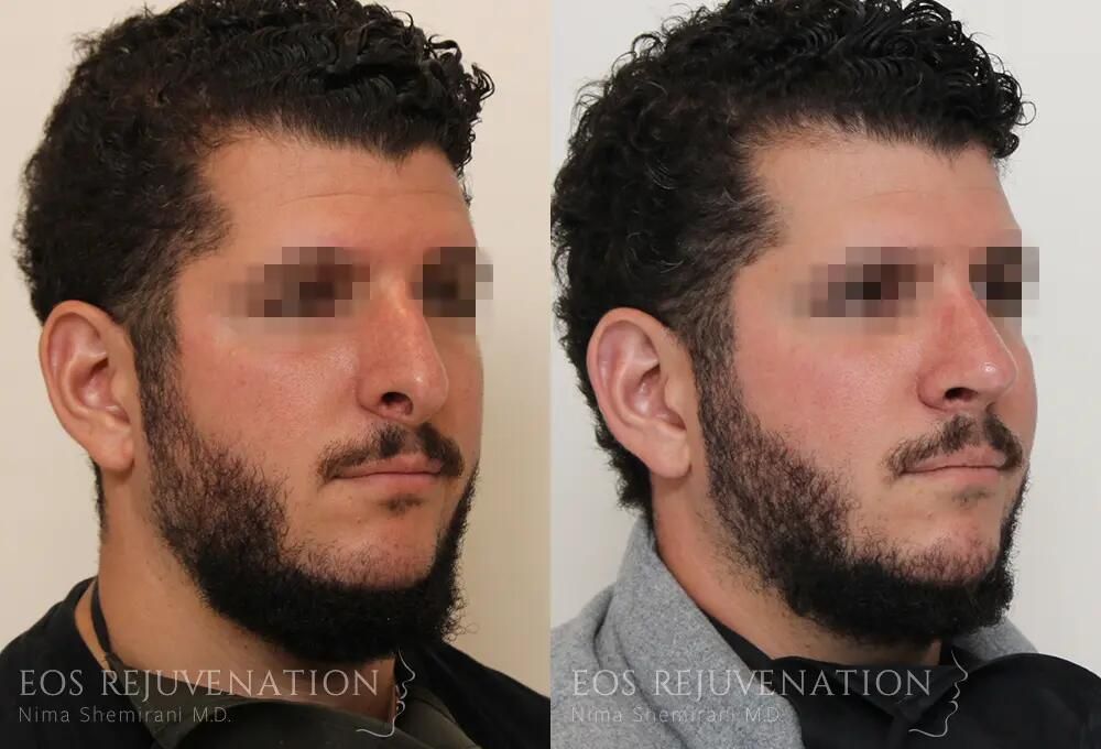 Revision Rhinoplasty Before & After