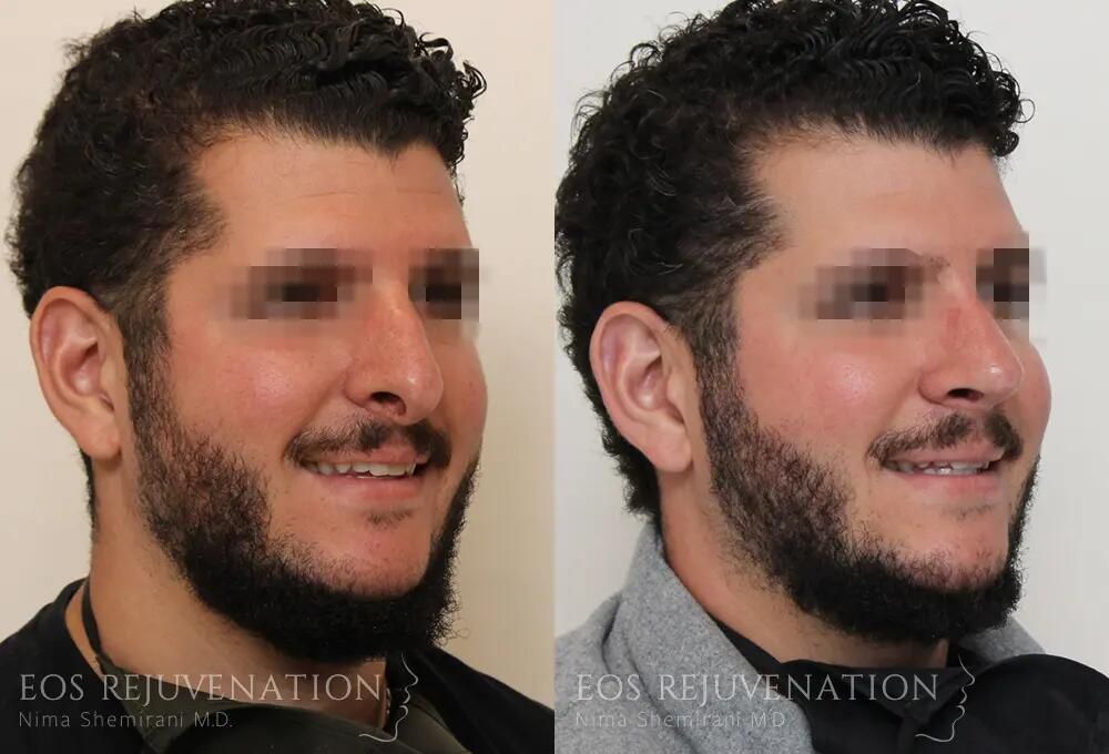 Revision Rhinoplasty Before & After