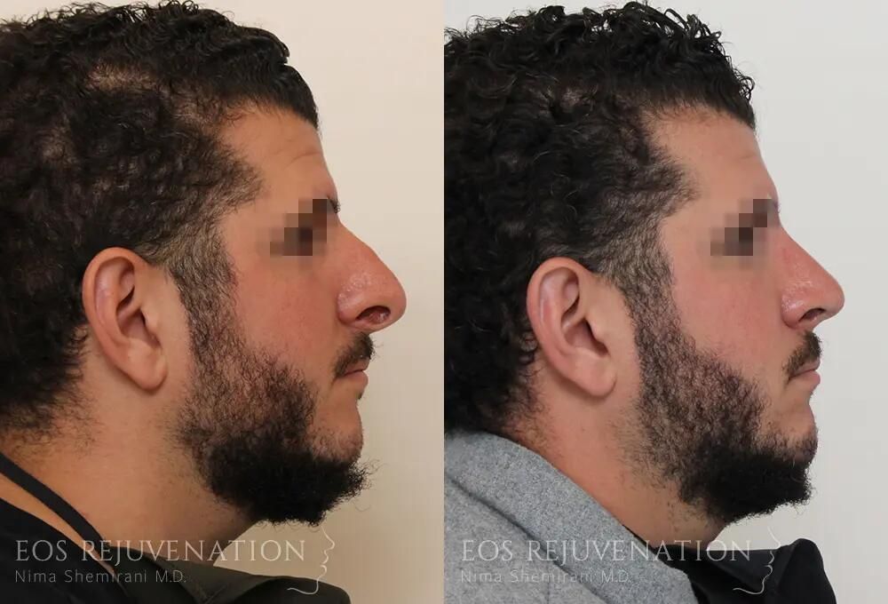 Revision Rhinoplasty Before & After