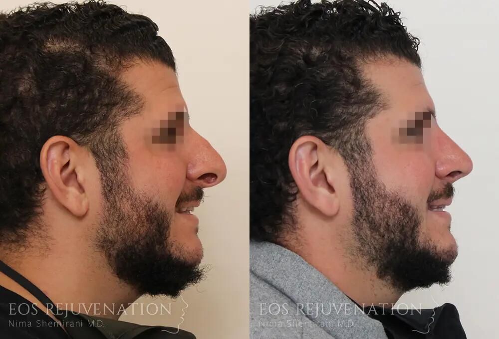 Revision Rhinoplasty Before & After