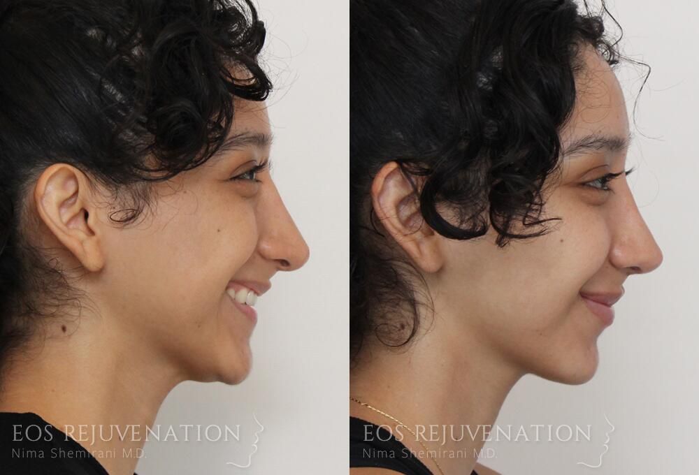 Revision Rhinoplasty Before & After