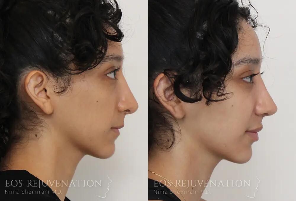 Revision Rhinoplasty Before & After