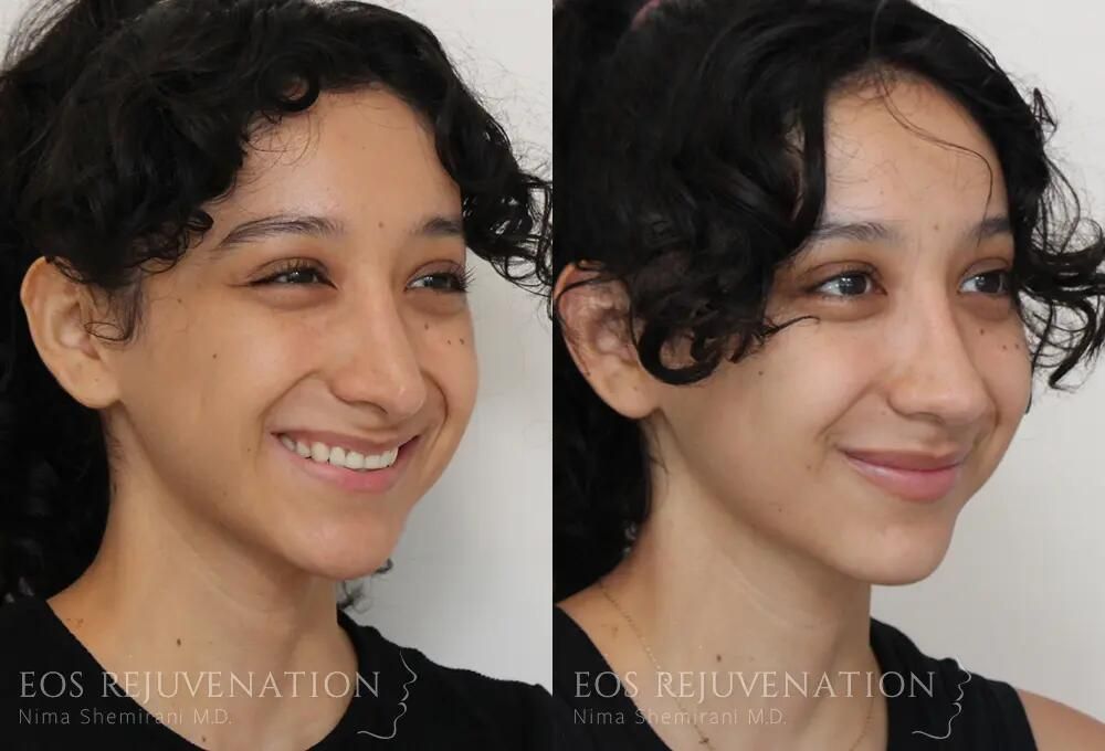 Revision Rhinoplasty Before & After