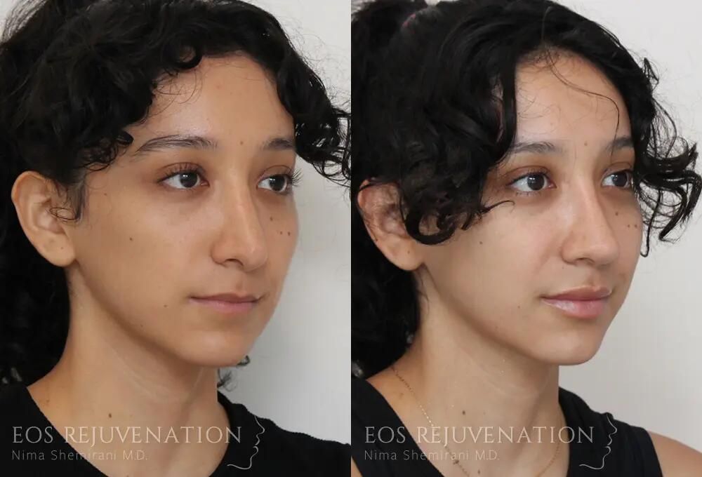 Revision Rhinoplasty Before & After