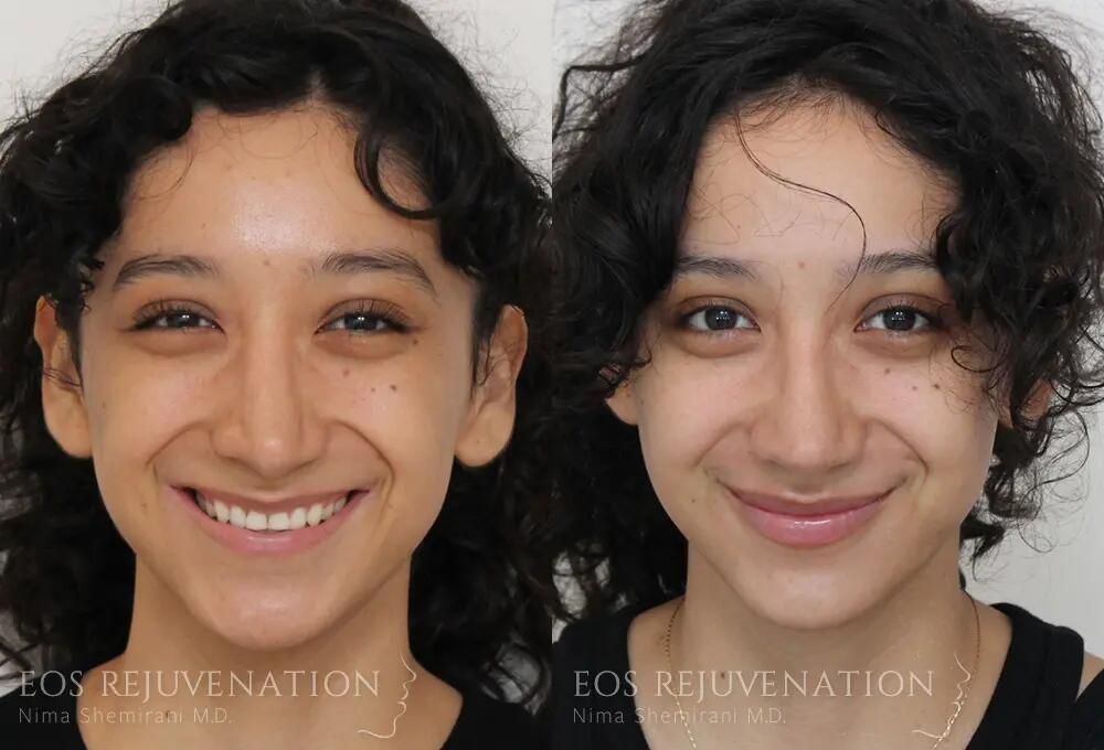 Revision Rhinoplasty Before & After