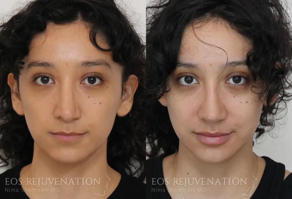 Revision Rhinoplasty Before & After