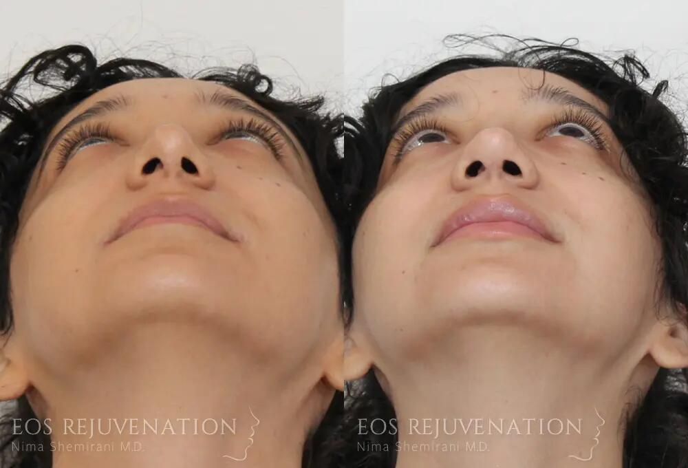Revision Rhinoplasty Before & After