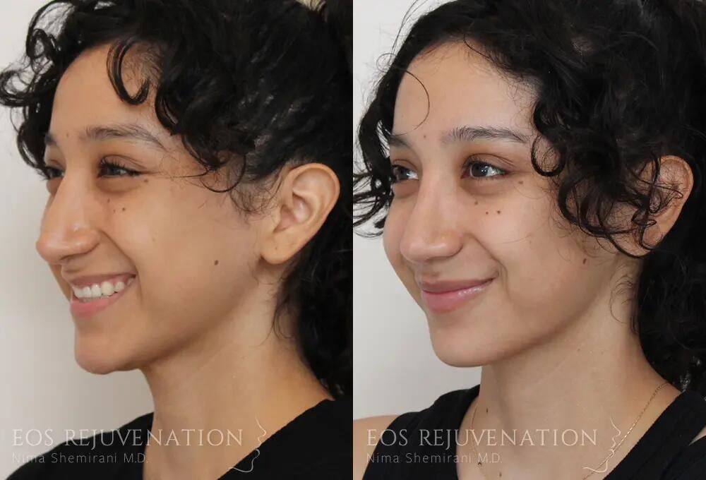 Revision Rhinoplasty Before & After