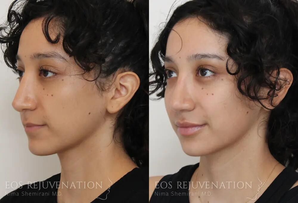 Revision Rhinoplasty Before & After