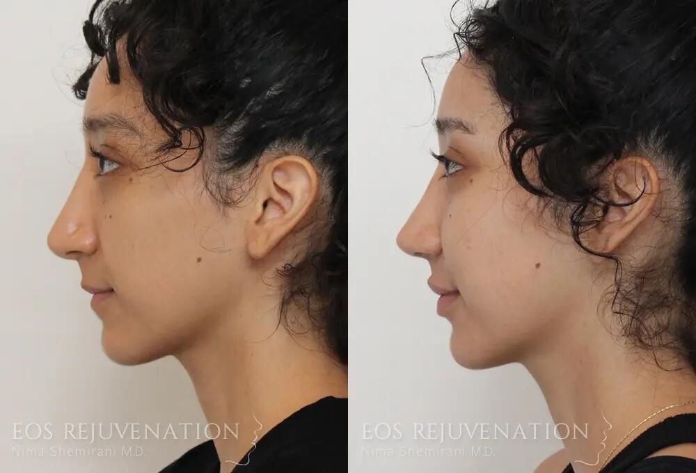 Revision Rhinoplasty Before & After
