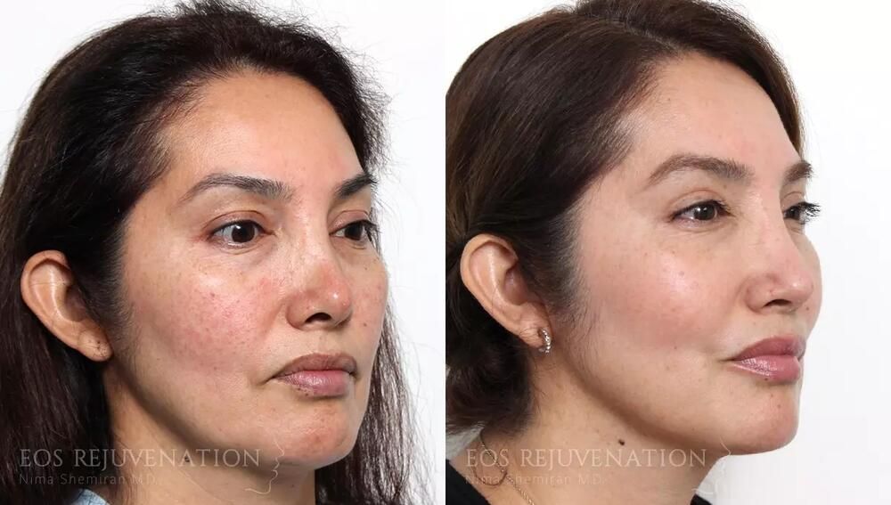 Revision Rhinoplasty Before & After