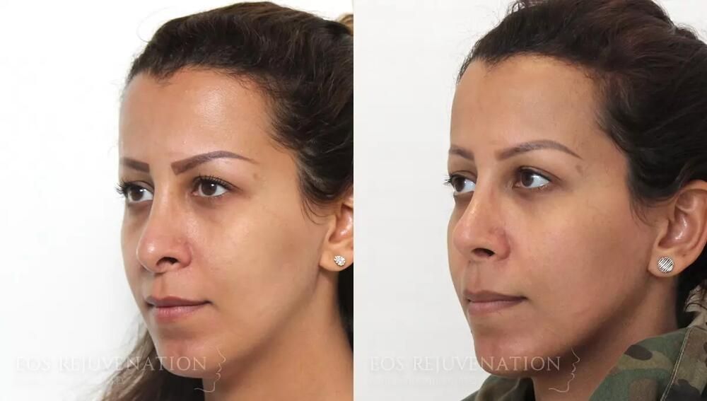 Revision Rhinoplasty Before & After