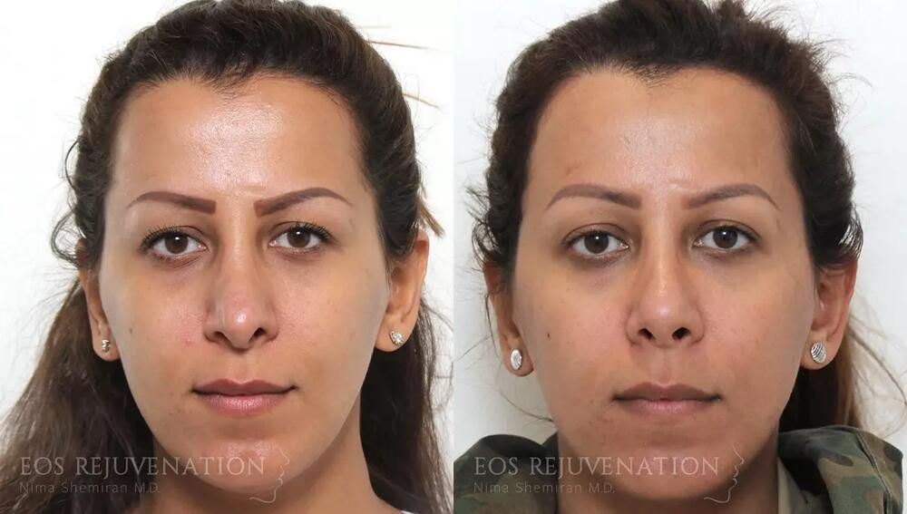Revision Rhinoplasty Before & After