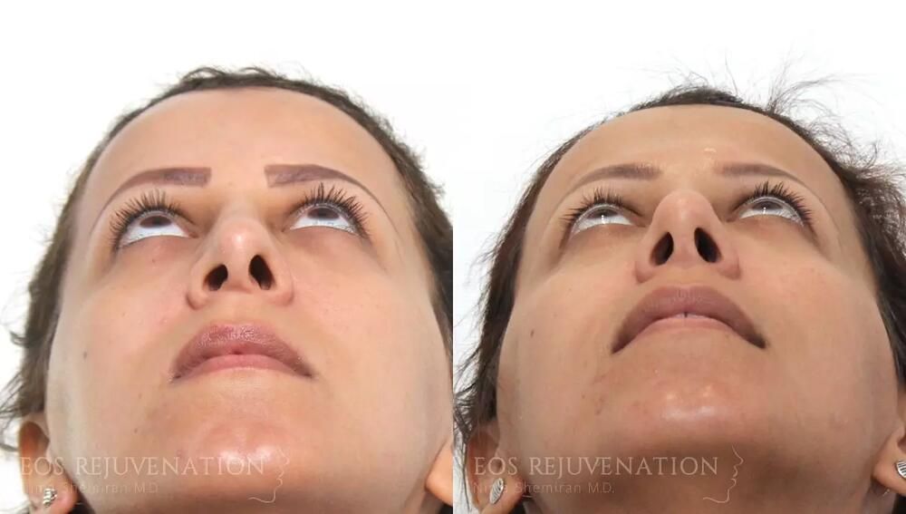 Revision Rhinoplasty Before & After