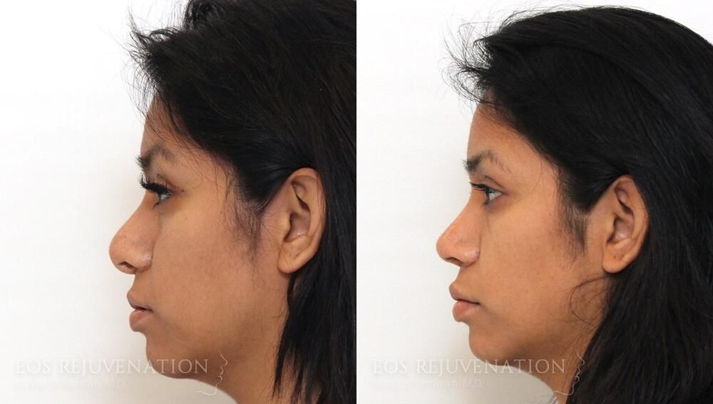 Revision Rhinoplasty Before & After