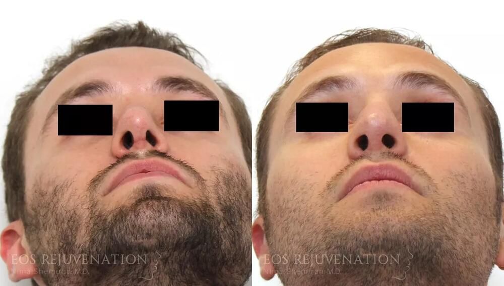 Revision Rhinoplasty Before & After