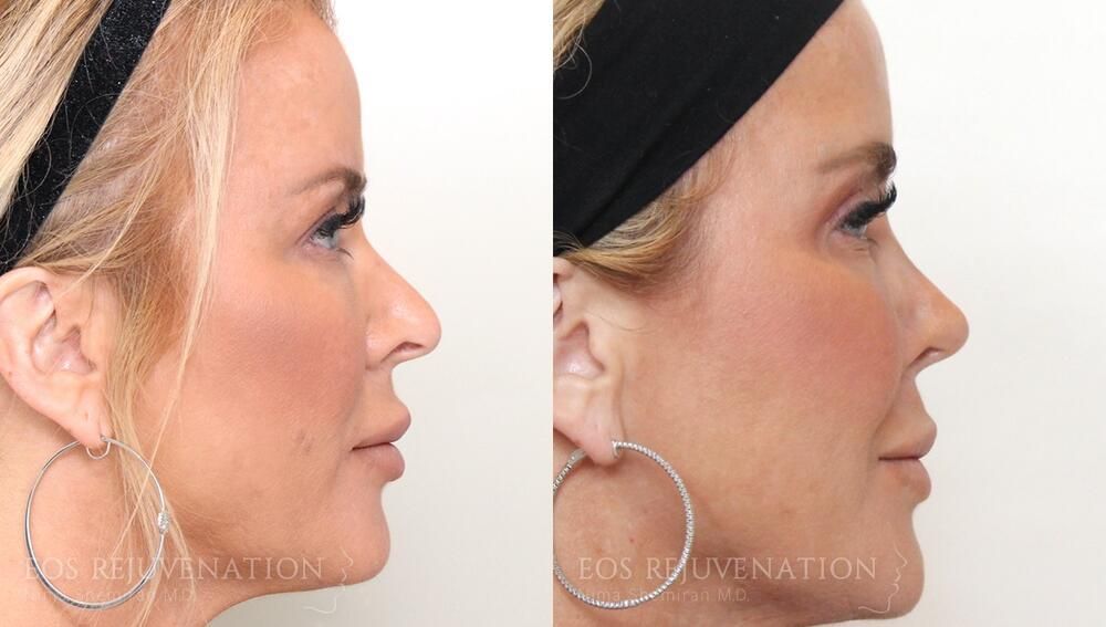 Revision Rhinoplasty Before & After