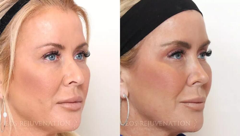 Revision Rhinoplasty Before & After