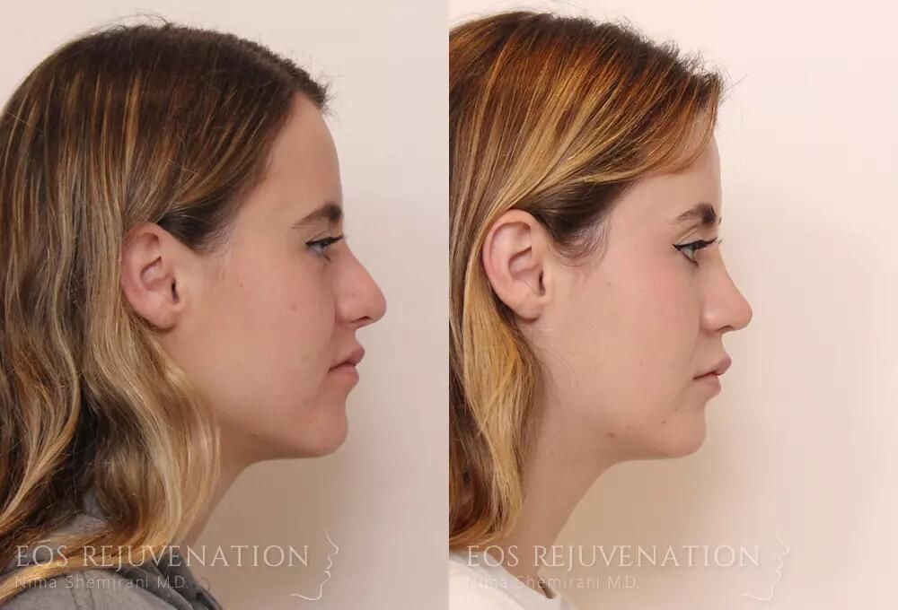 Revision Rhinoplasty Before & After