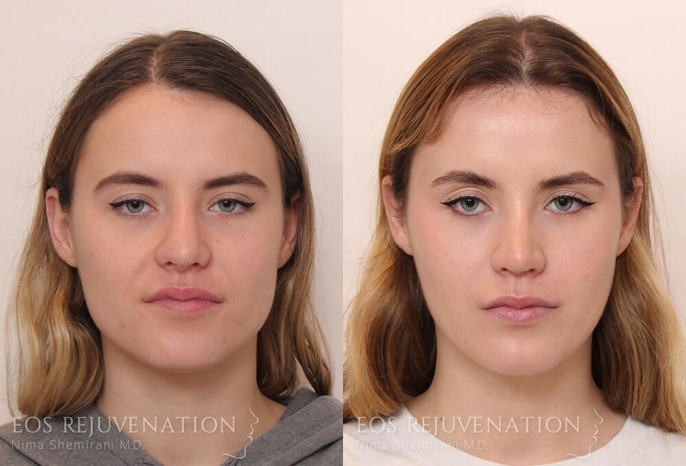 Revision Rhinoplasty Before & After