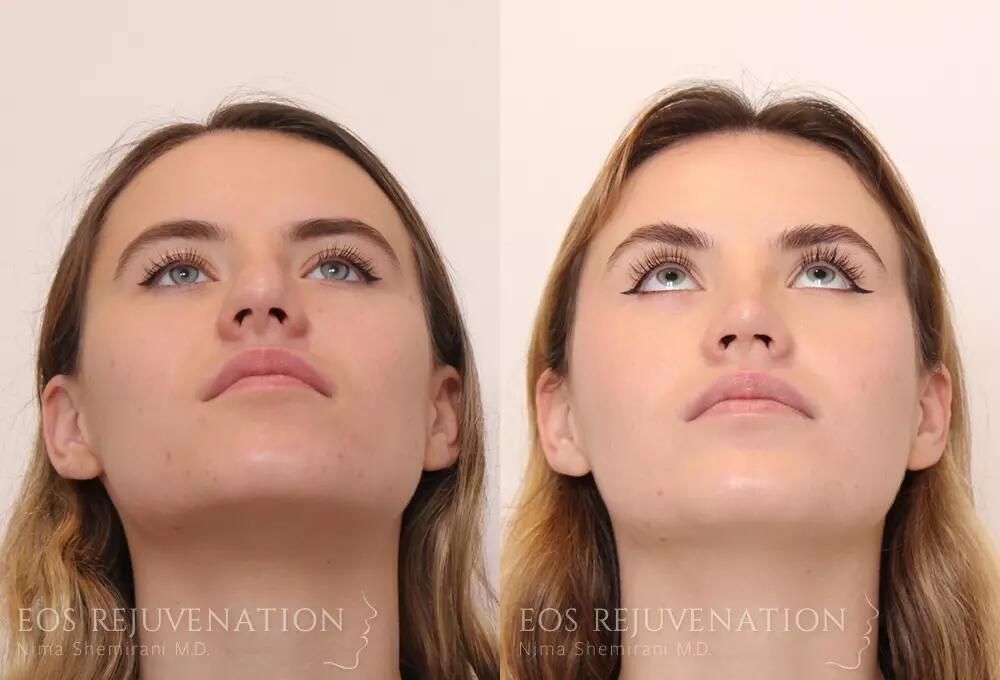 Revision Rhinoplasty Before & After