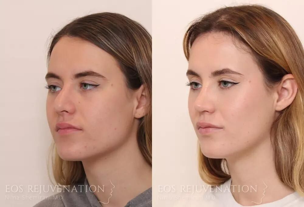 Revision Rhinoplasty Before & After
