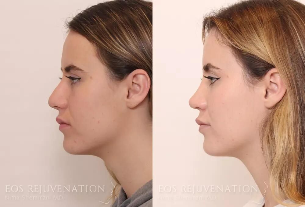 Revision Rhinoplasty Before & After