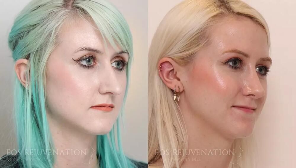 Revision Rhinoplasty Before & After