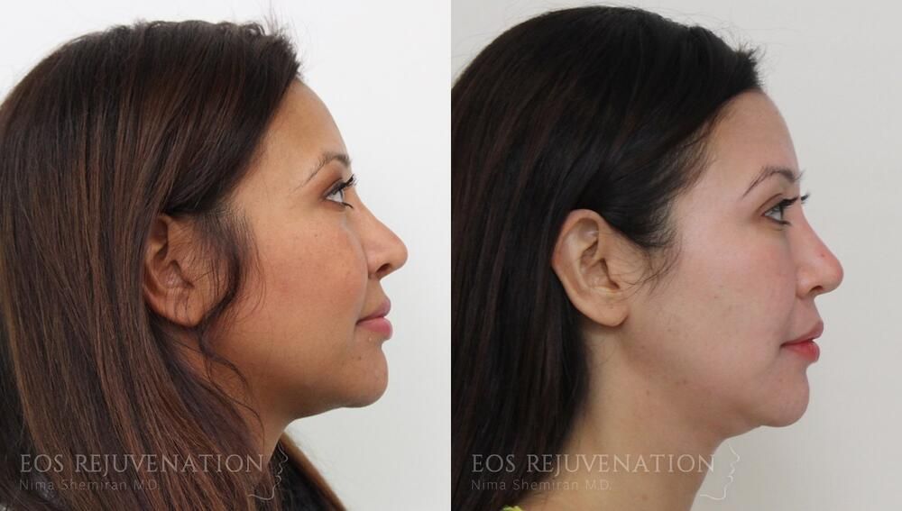 Revision Rhinoplasty Before & After