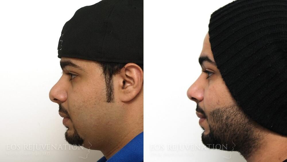Revision Rhinoplasty Before & After