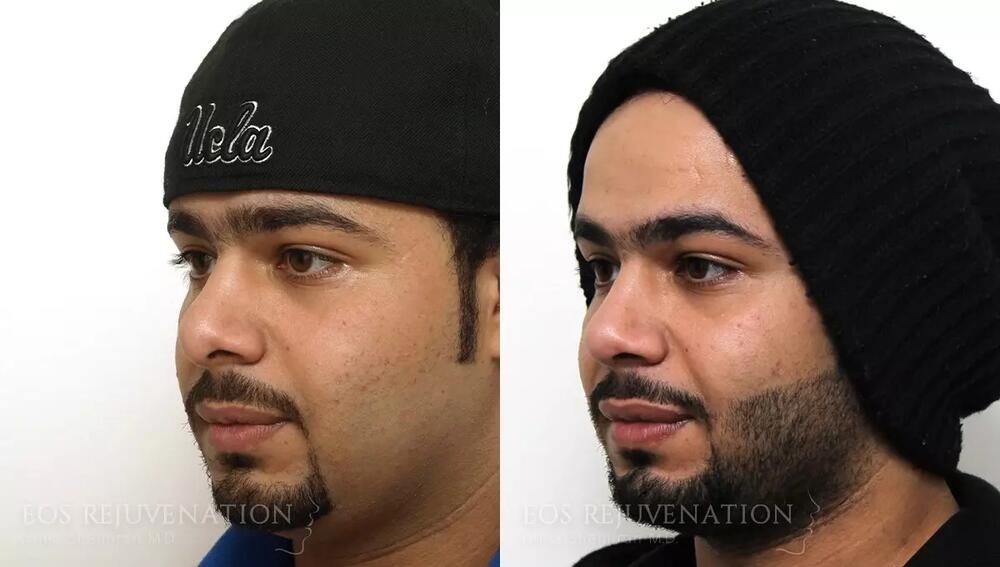 Revision Rhinoplasty Before & After