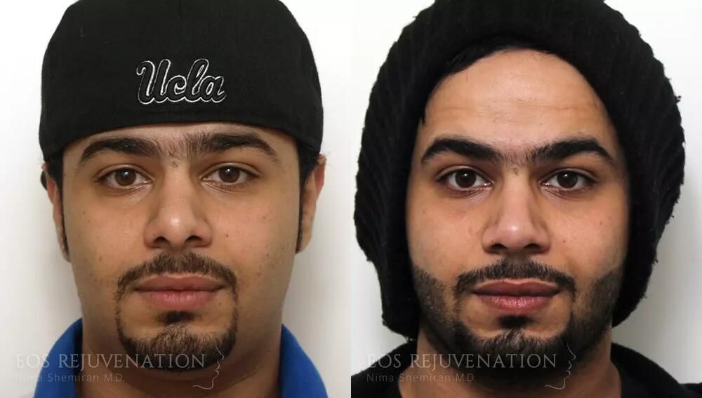 Revision Rhinoplasty Before & After