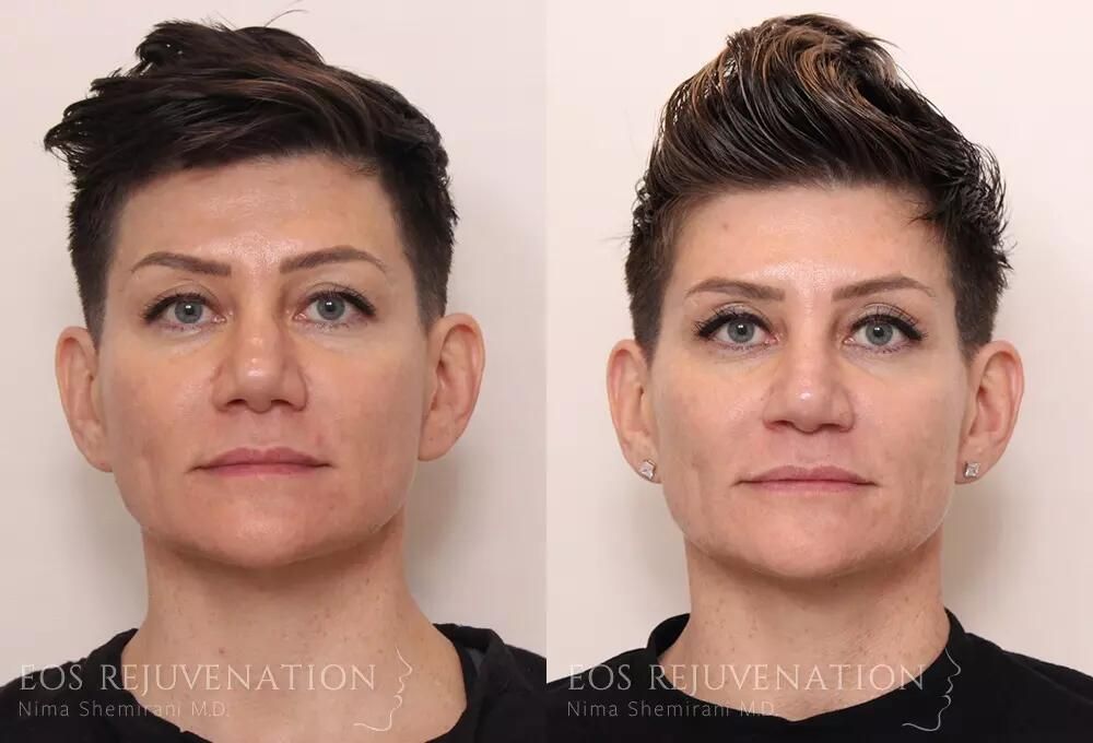 Revision Rhinoplasty Before & After