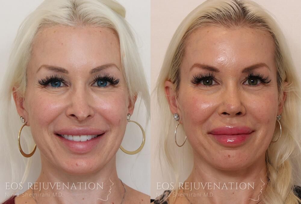 Revision Rhinoplasty Before & After