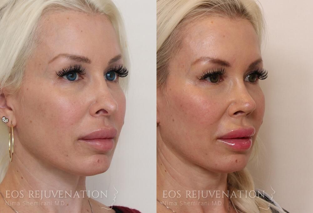 Revision Rhinoplasty Before & After
