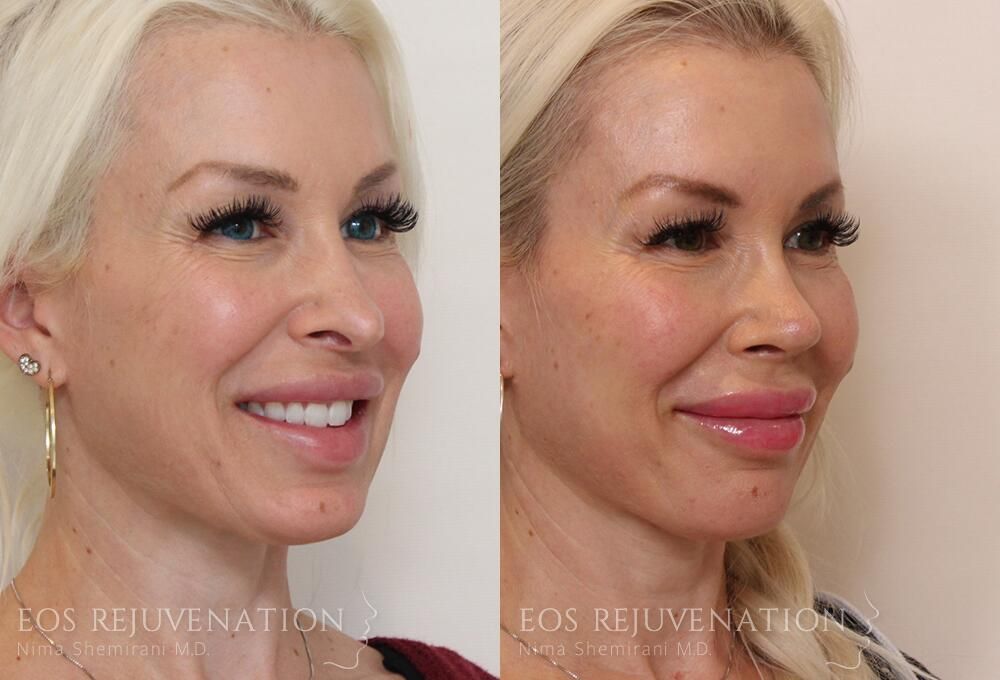 Revision Rhinoplasty Before & After