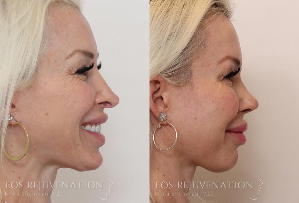 Revision Rhinoplasty Before & After