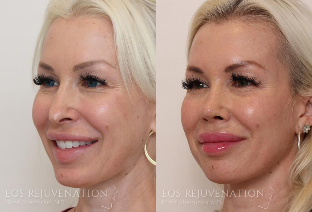 Revision Rhinoplasty Before & After