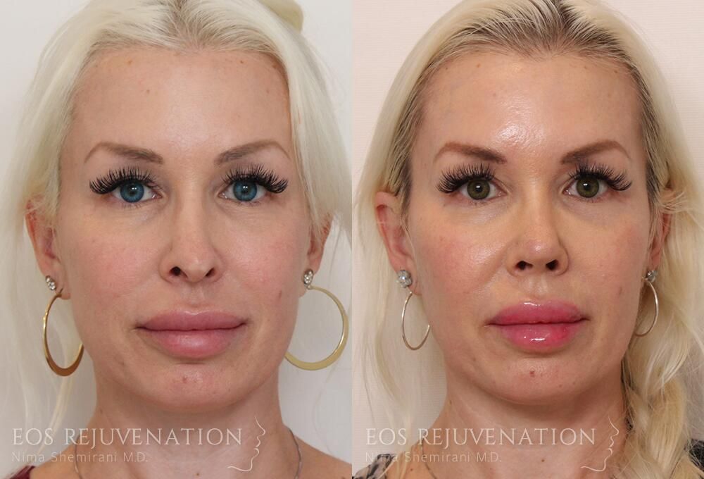 Revision Rhinoplasty Before & After