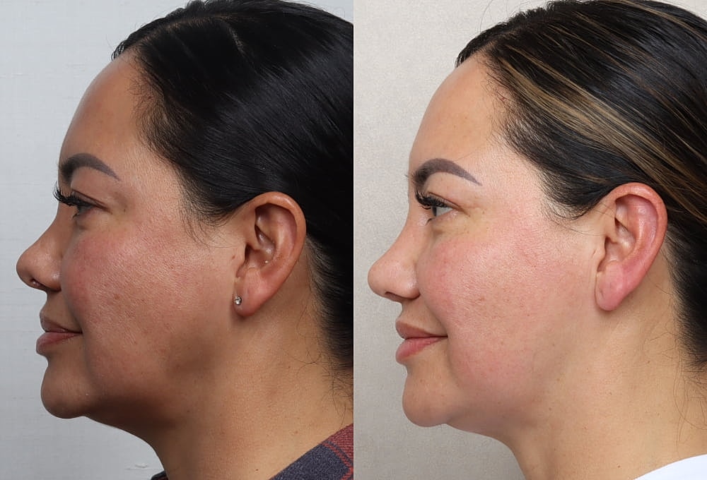 Before and after facial transformation comparison.