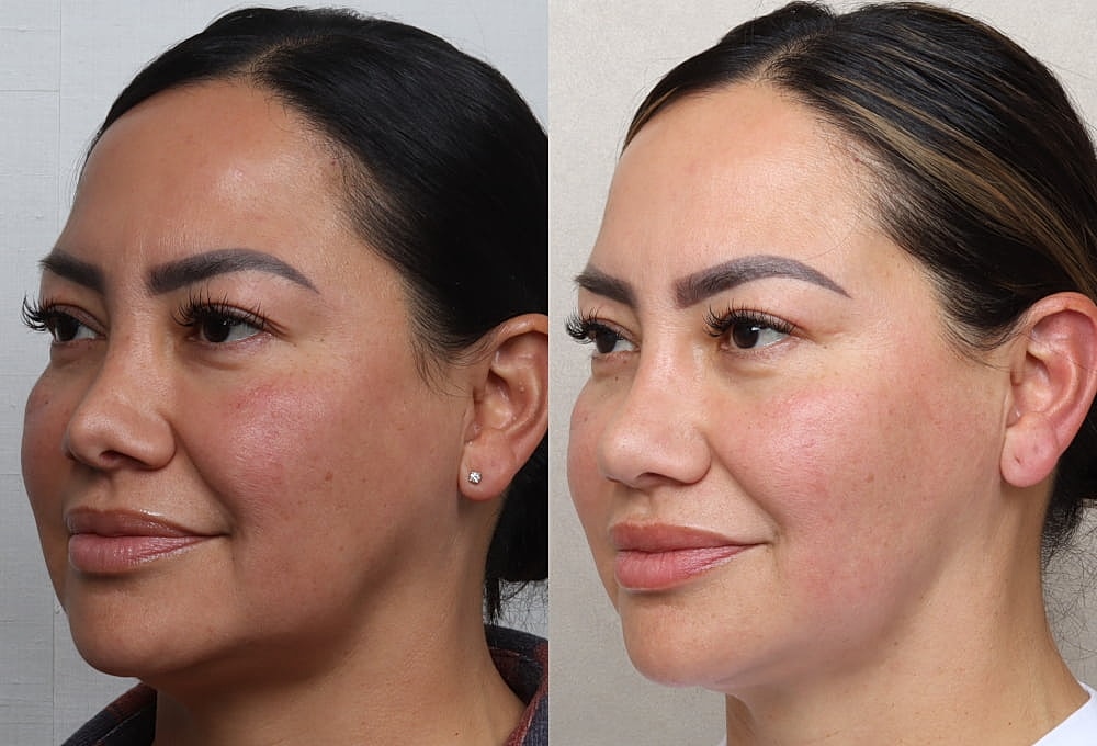 Before and after facial transformation comparison.