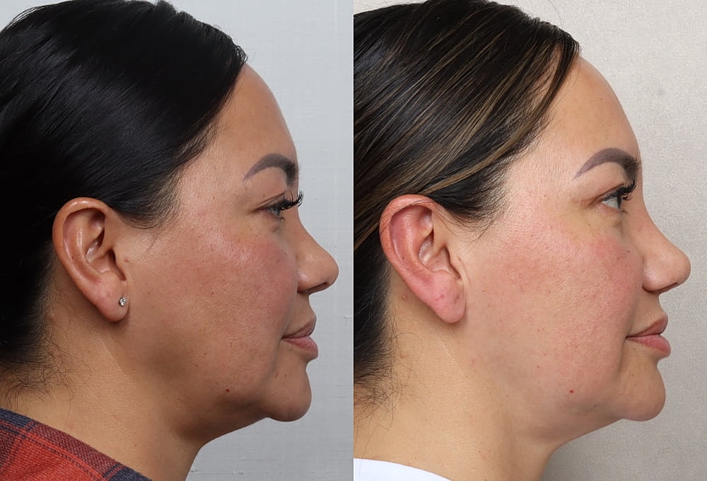 Before and after profile photos of a woman.