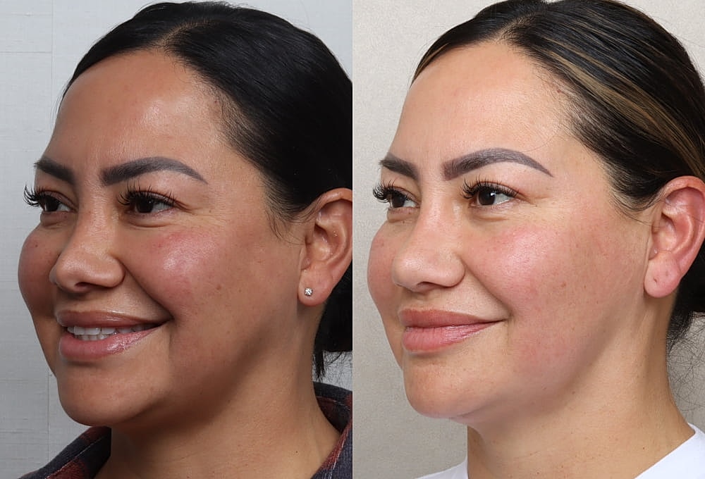 Before and after facial transformation comparison.