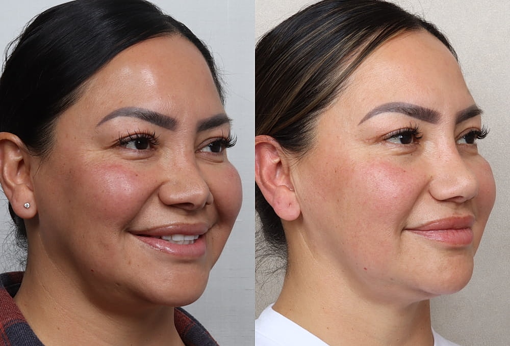 Before and after cosmetic procedure comparison.