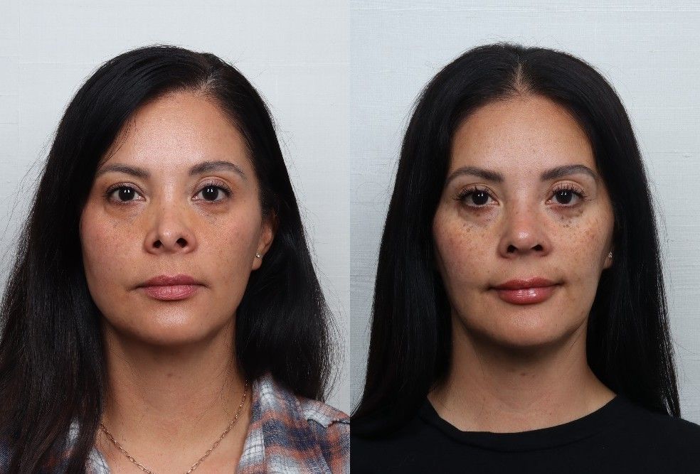 Revision Rhinoplasty Before & After