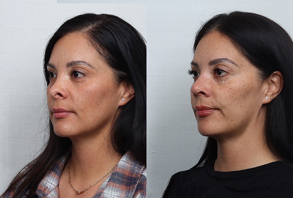 Revision Rhinoplasty Before & After